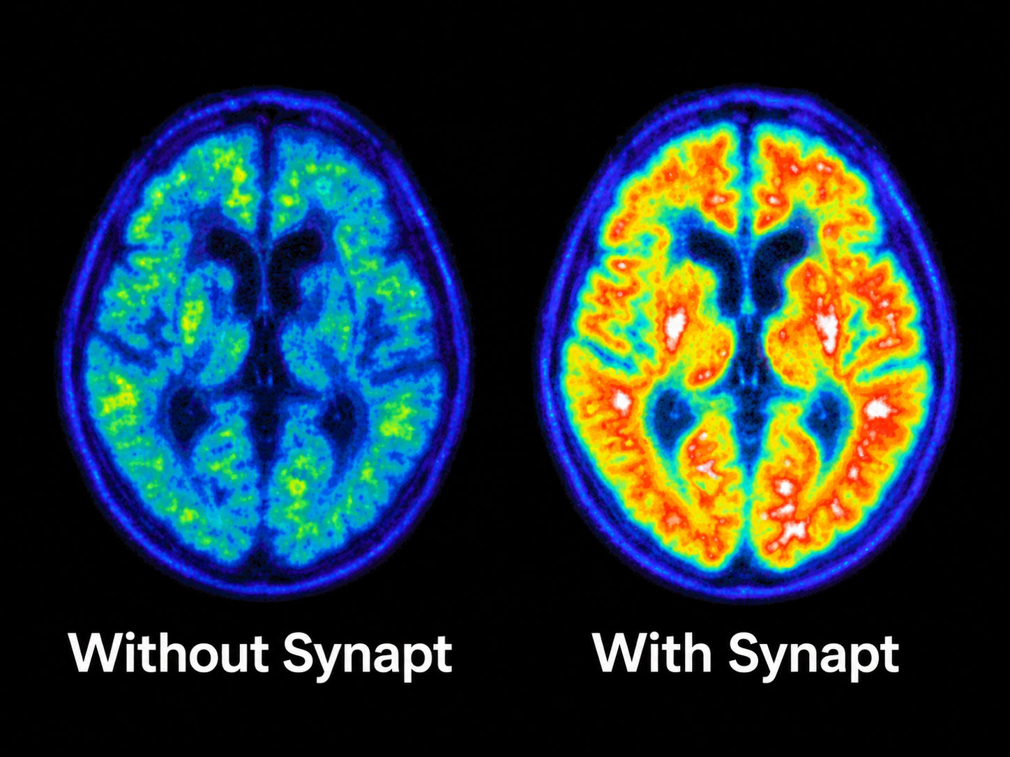 Brain scan comparison: without Synapt vs with Synapt